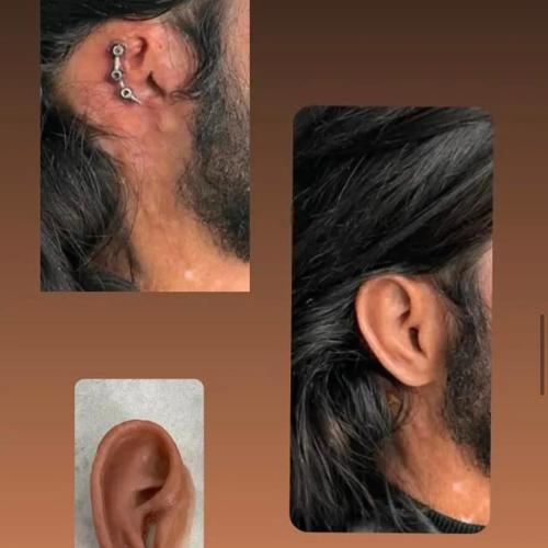 Reconstrucción de la oreja Fotos del antes y el después